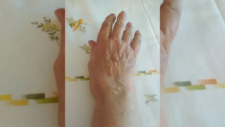 Romatoid artritten etkilenmiş el eklemlerini gösteren klinik fotoğraf – yatay arşiv kapağı